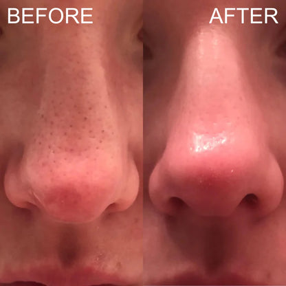 Blackhead Remover Suction Machine